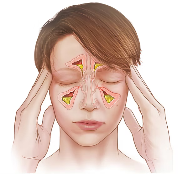 Rinite alérgica e obstrução nasal - Dra. Lumy Yagueshita
